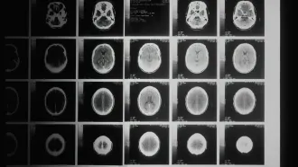 Global study examines Parkinson’s genes to support precision therapies