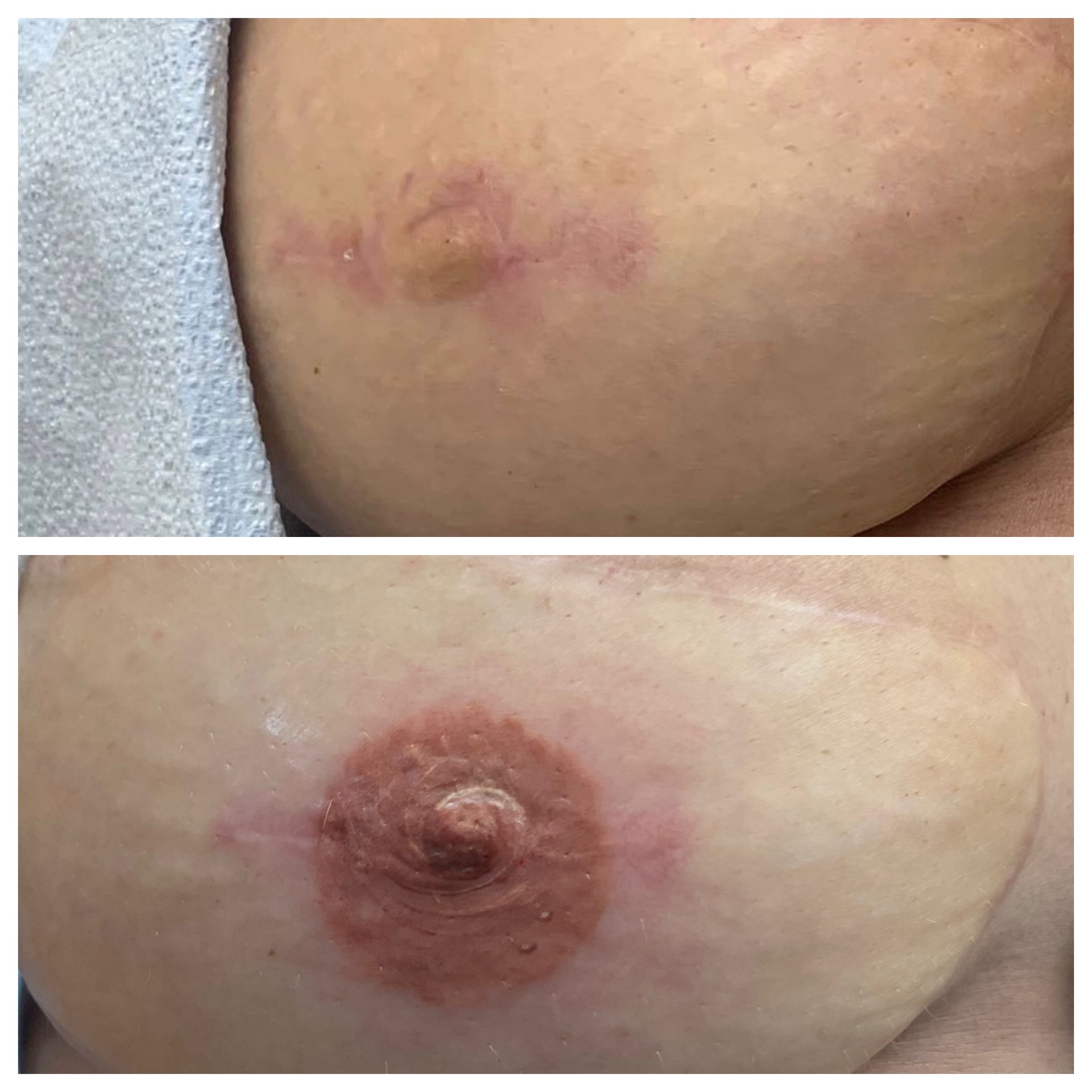 breast cancer nipple tattoo sample before and after 16