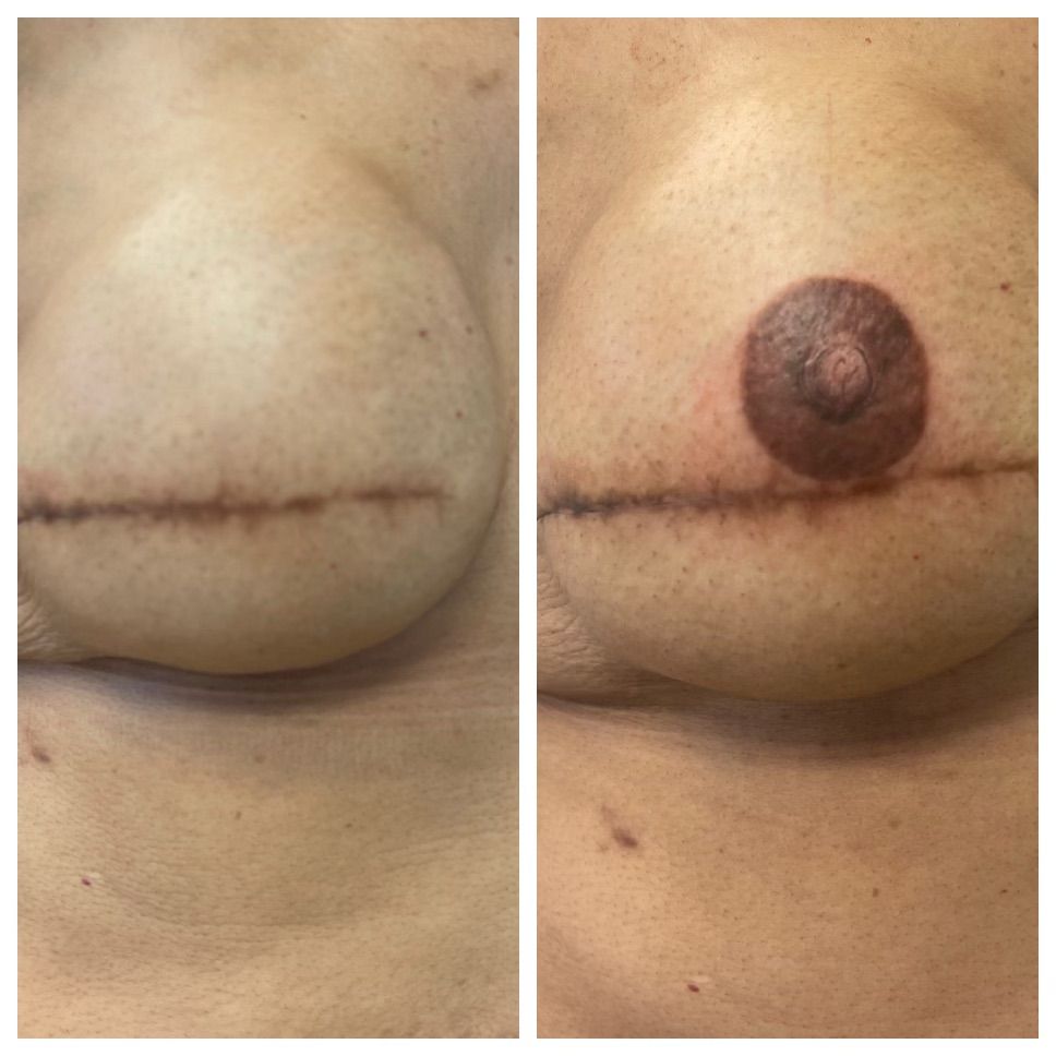 breast cancer nipple tattoo sample before and after 9