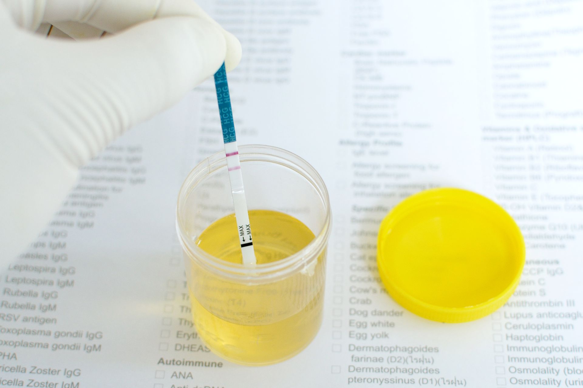 Gloved hand holding a test strip over a yellow urine sample in a clear cup on a lab report