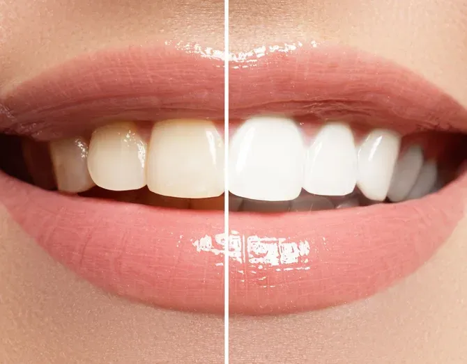 Tooth Whitening - Atlanta, GA - Downtown Dental Center Tooth Whitening - Atlanta, GA - Downtown Dental Center