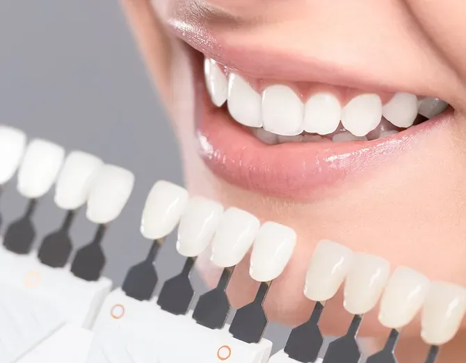 Veneers - Atlanta, GA - Downtown Dental Center Veneers - Atlanta, GA - Downtown Dental Center