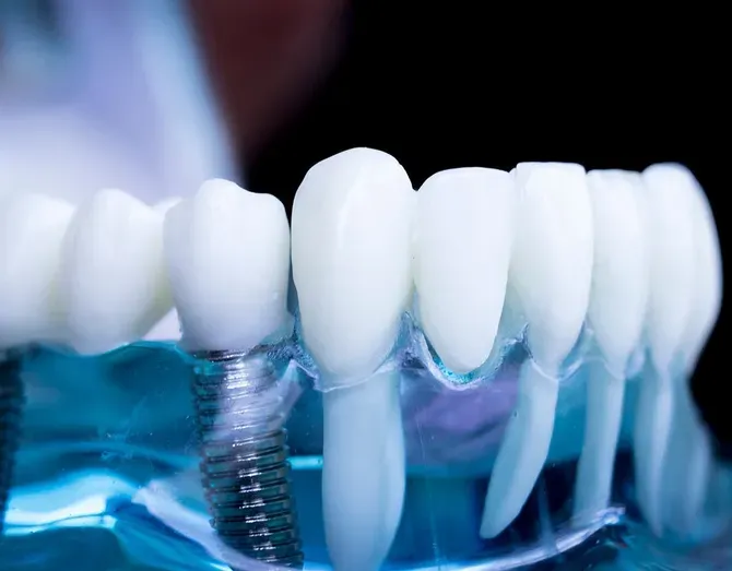 Crowns And Bridges - Atlanta, GA - Downtown Dental Center Crowns And Bridges - Atlanta, GA - Downtown Dental Center