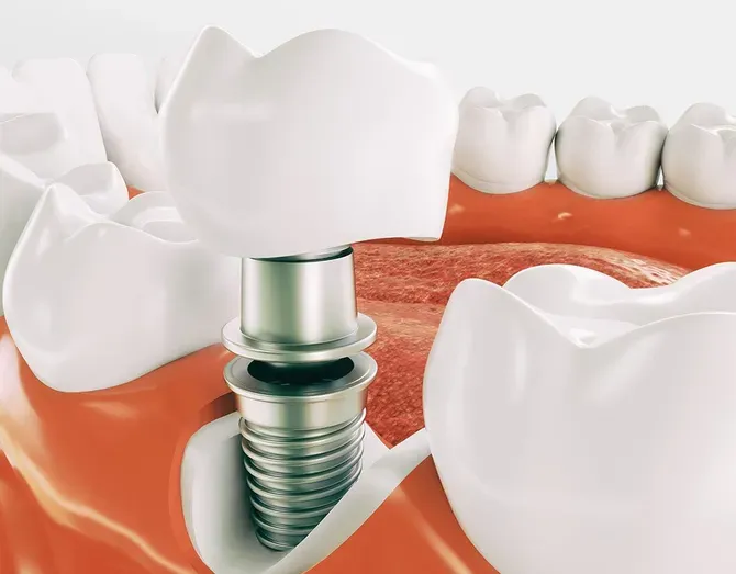 Dental Implants - Atlanta, GA - Downtown Dental Center Dental Implants - Atlanta, GA - Downtown Dental Center