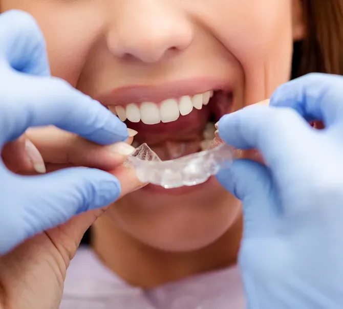 Invisalign - Atlanta, GA - Downtown Dental Center Invisalign - Atlanta, GA - Downtown Dental Center