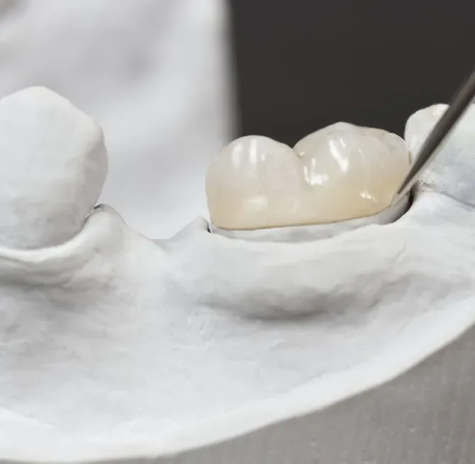 Inlays, Onlays, And Crowns - Atlanta, GA - Downtown Dental Center Inlays, Onlays, And Crowns - Atlanta, GA - Downtown Dental Center