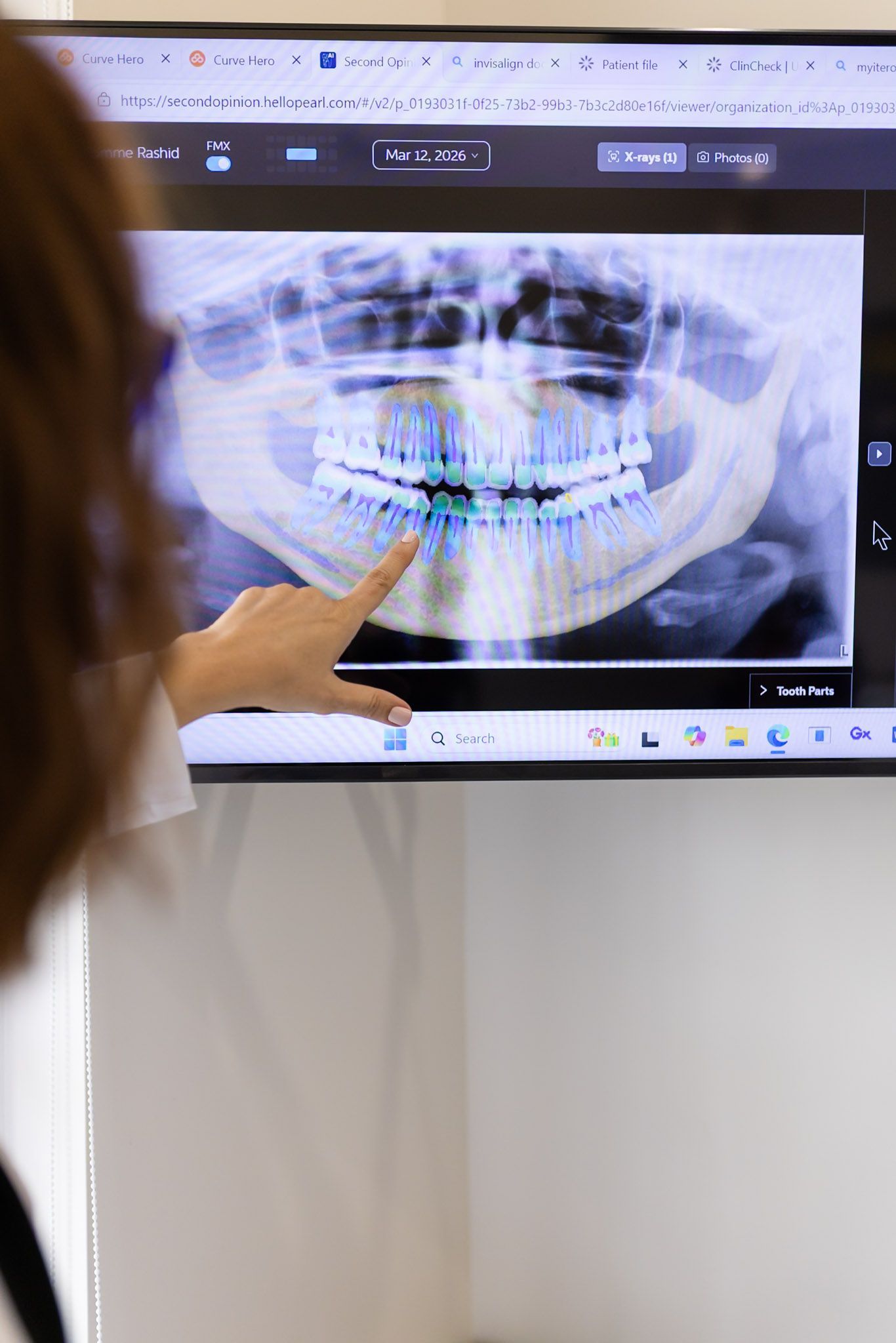 Panoramic X-ray on screen for dental implant planning at GEN2 Dentistry