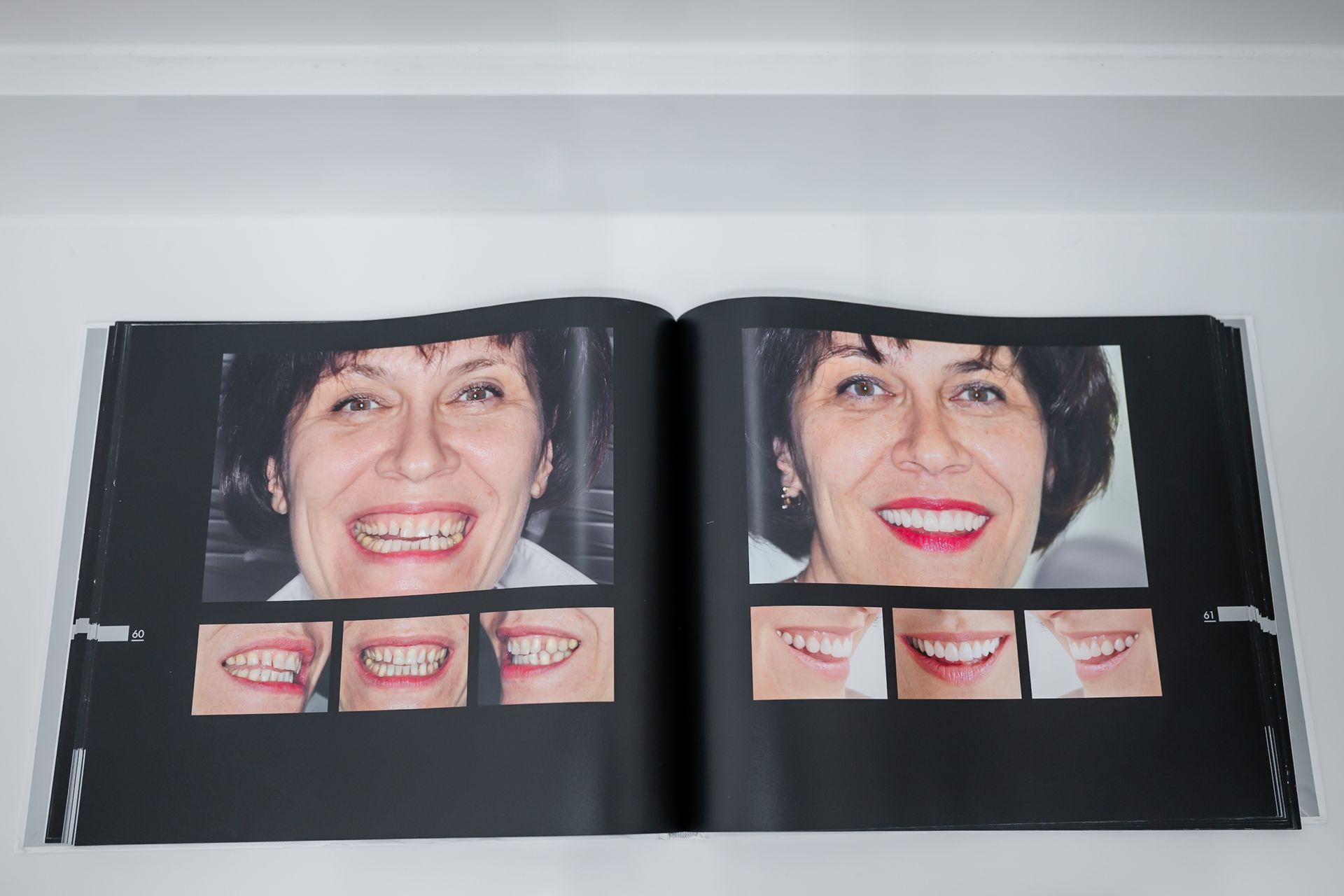 Before-and-after smile makeover photos with veneers shown in a printed portfolio