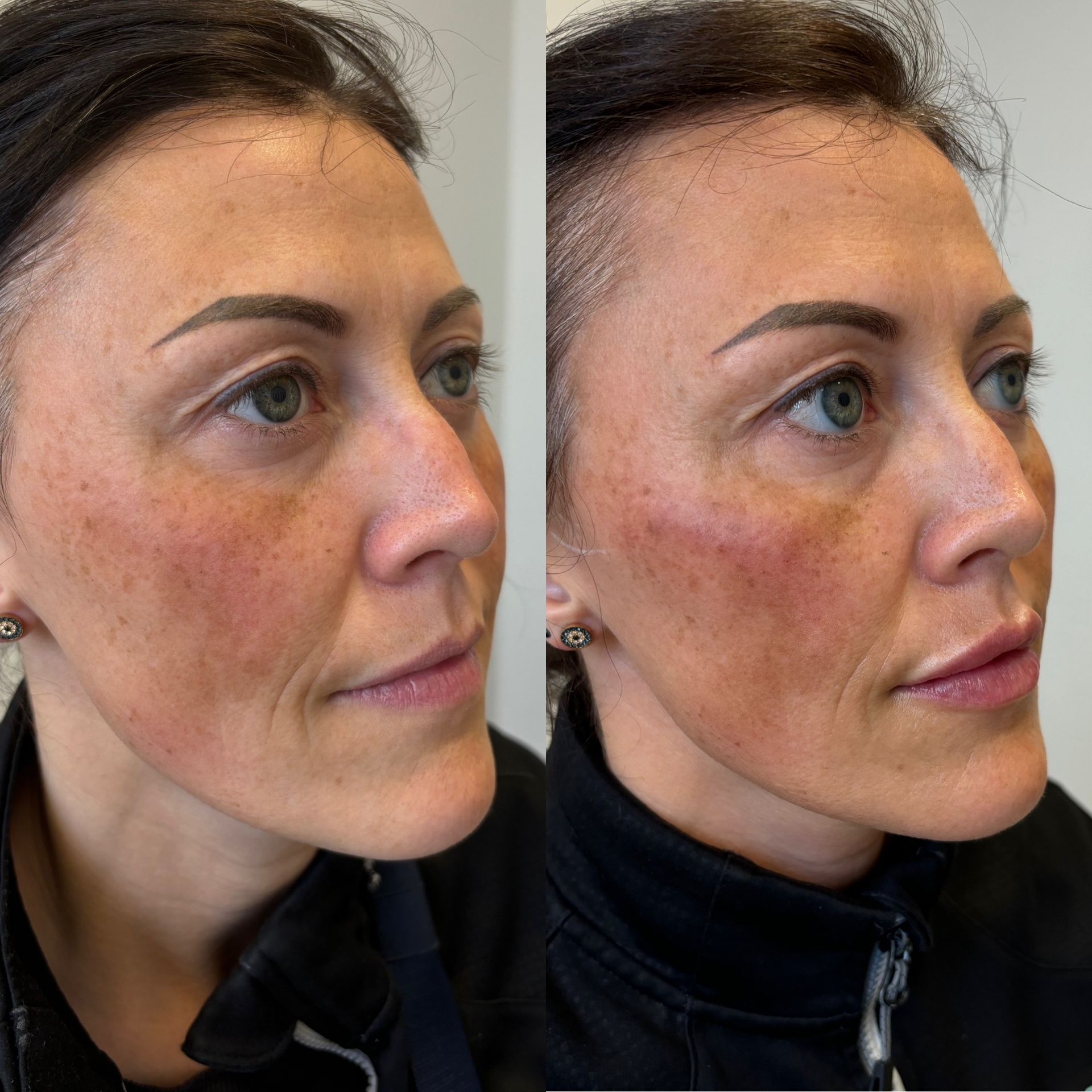 Side-by-side comparison of a person's face before and after cosmetic treatment showing reduced facial lines and volume.
