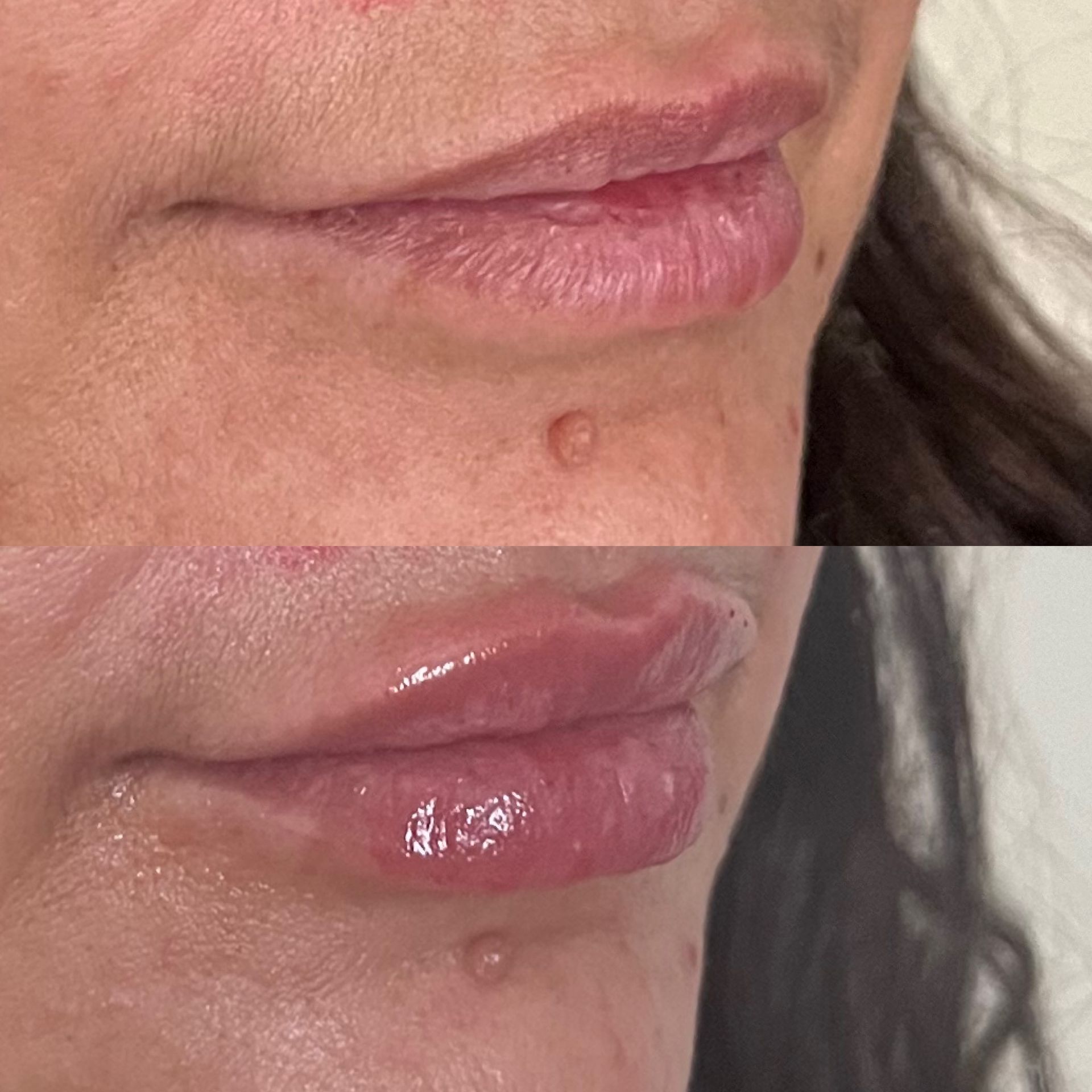 A before and after photo of a woman 's lips.