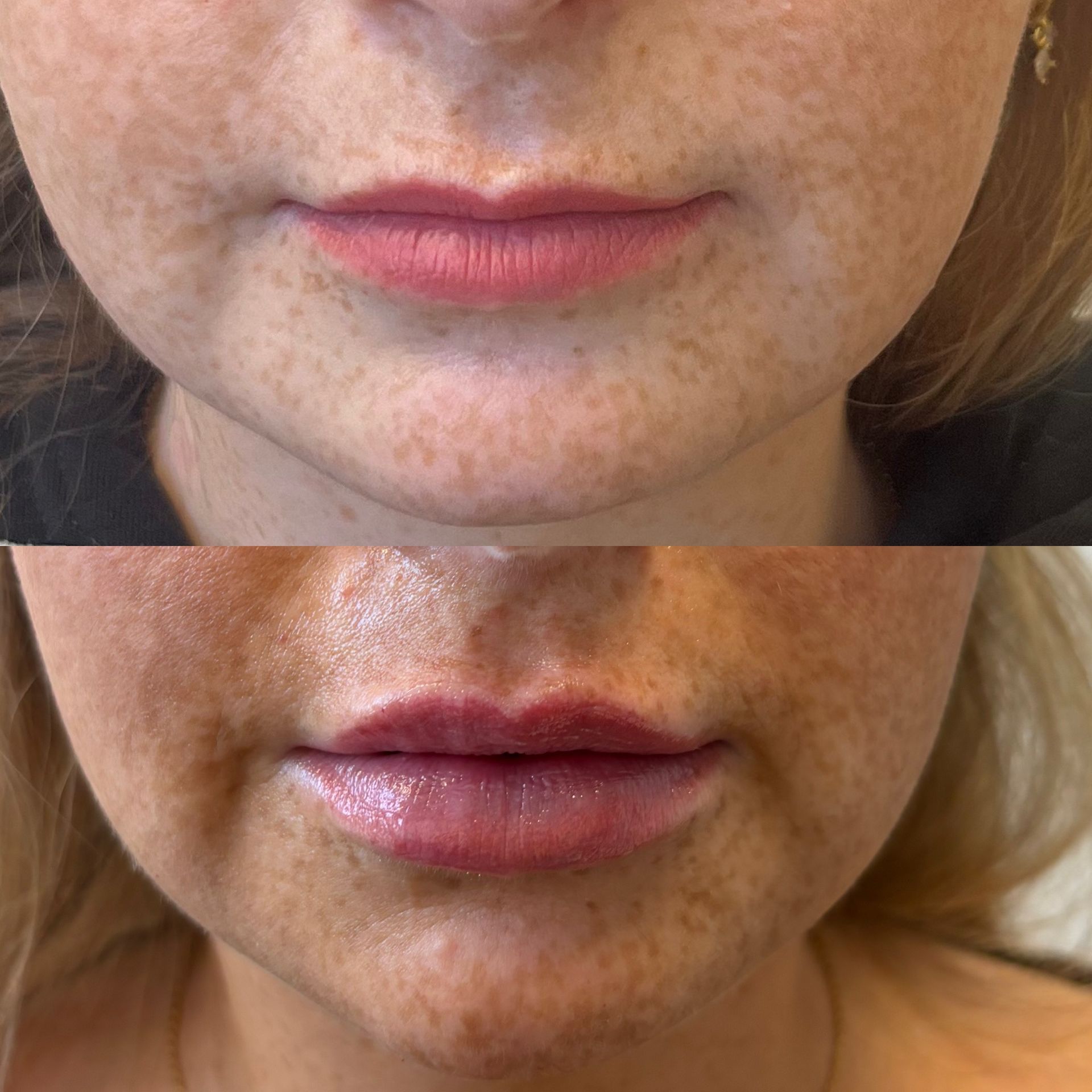 A before and after photo of a woman's lips.