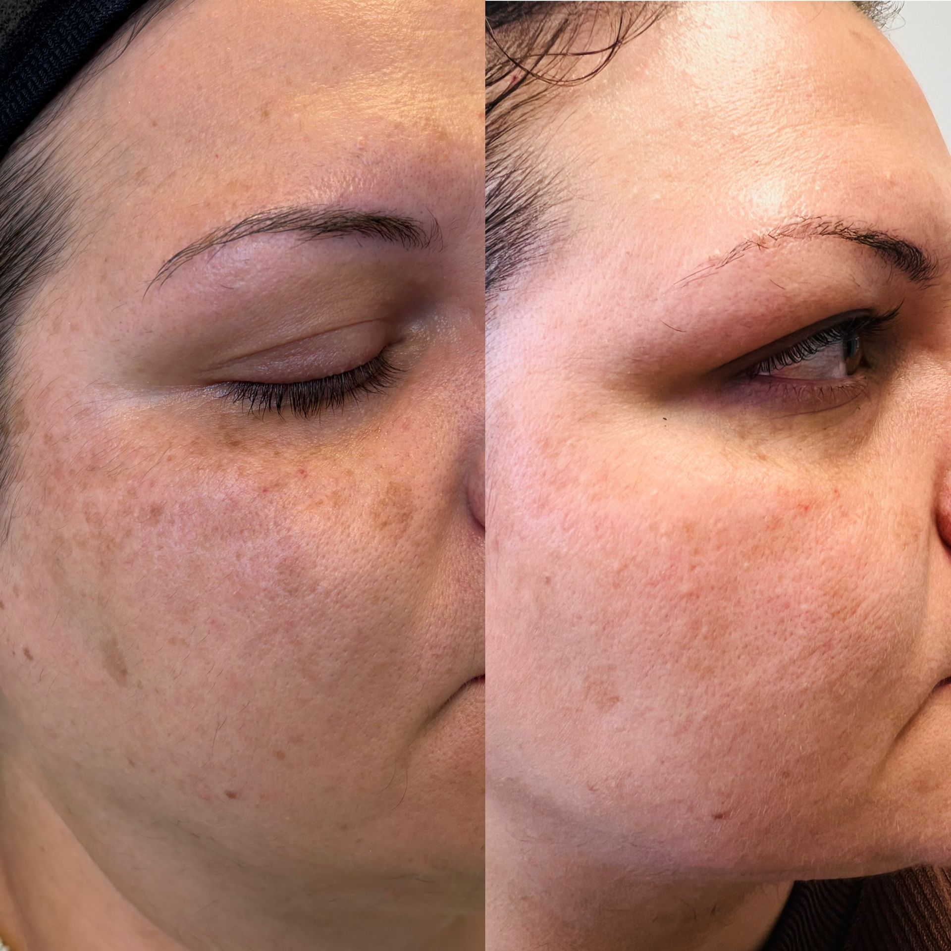 A woman's face is shown before and after a treatment.