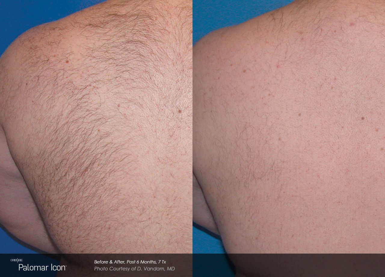 A before and after photo of a man's back