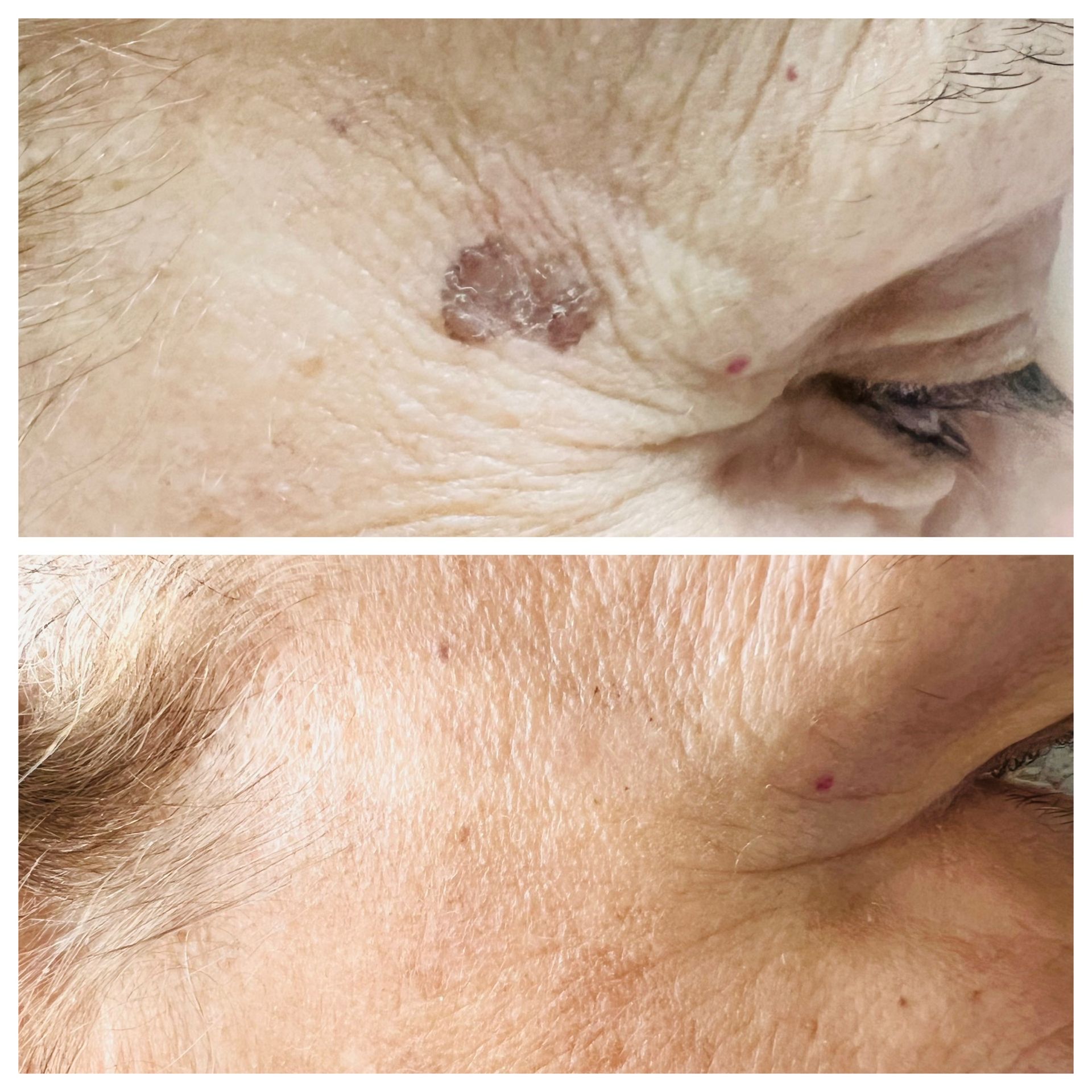 Close-up of skin near the eye, showing a raised brown spot before and after treatment