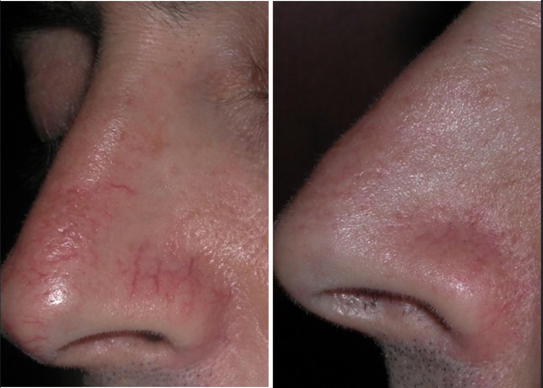 Side-by-side close-up of a nose before and after one facial vascular treatment.