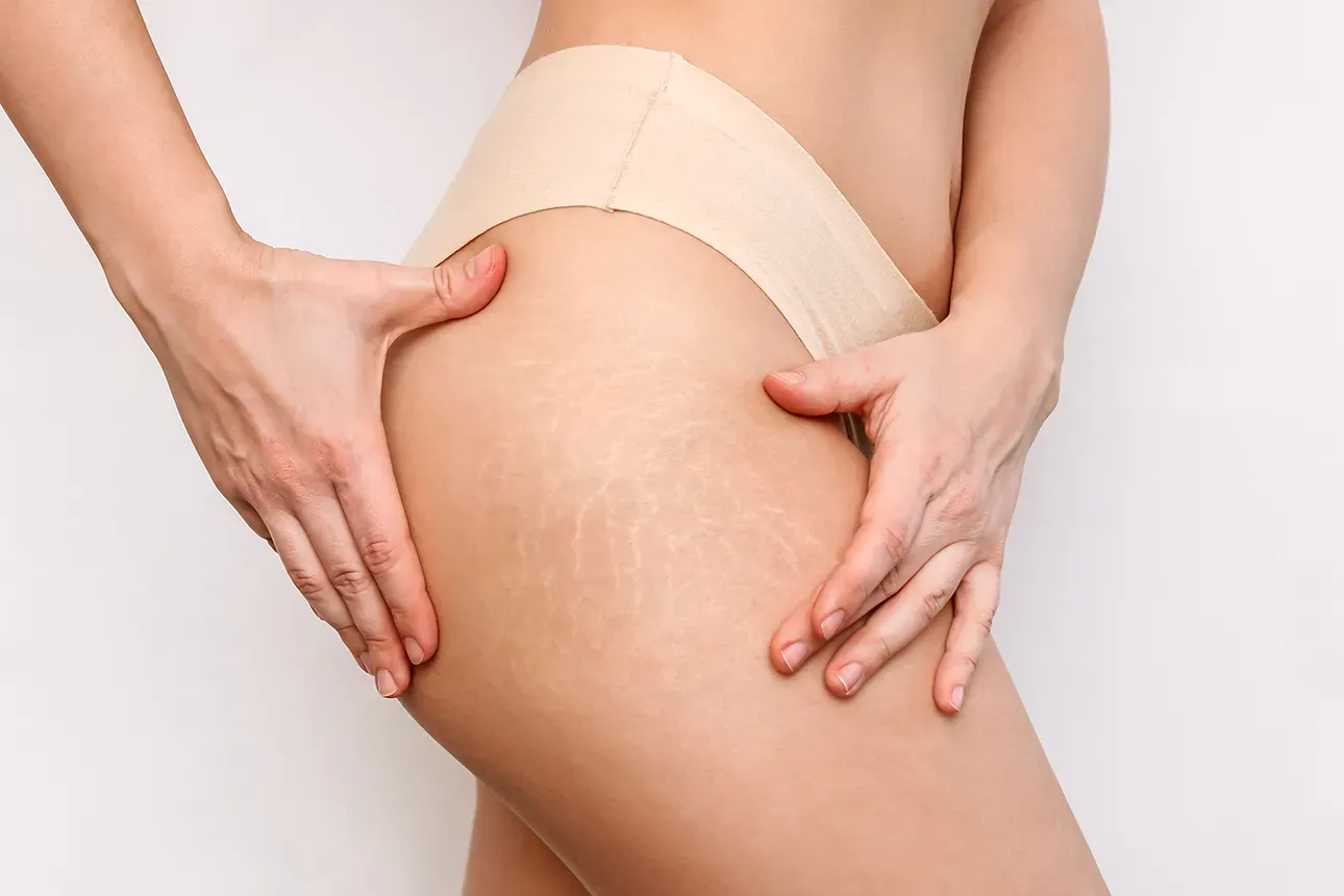 Mani che massaggiano una gamba con cellulite visibile su uno sfondo neutro