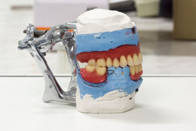 Close Up of Partial Denture — Goonellabah Denture Clinic In Goonellabah, NSW