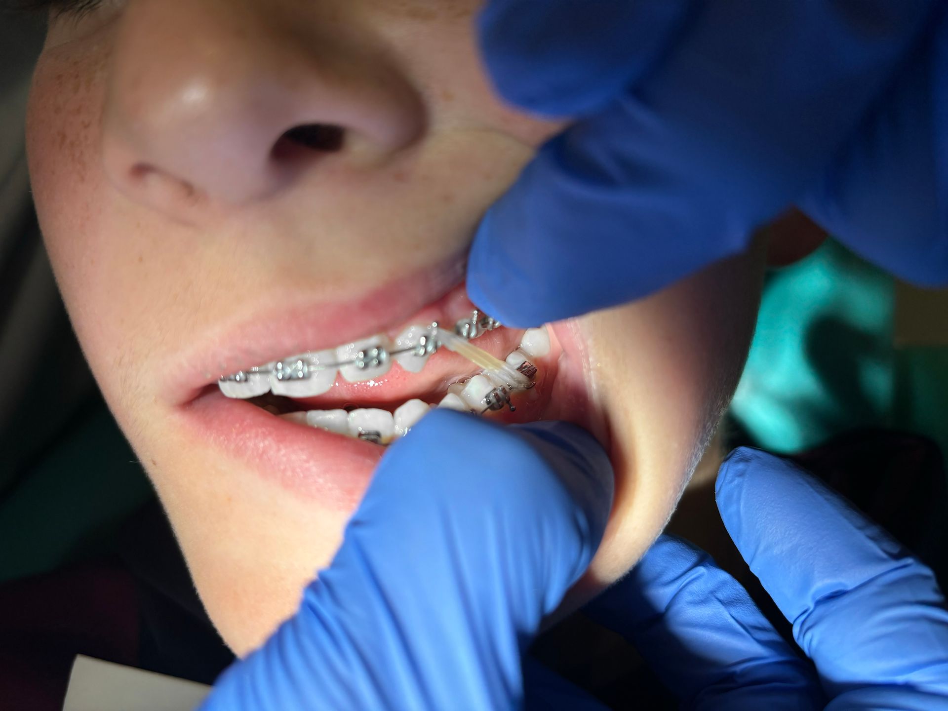 Dentist hands putting elastic bands over dental brackets.