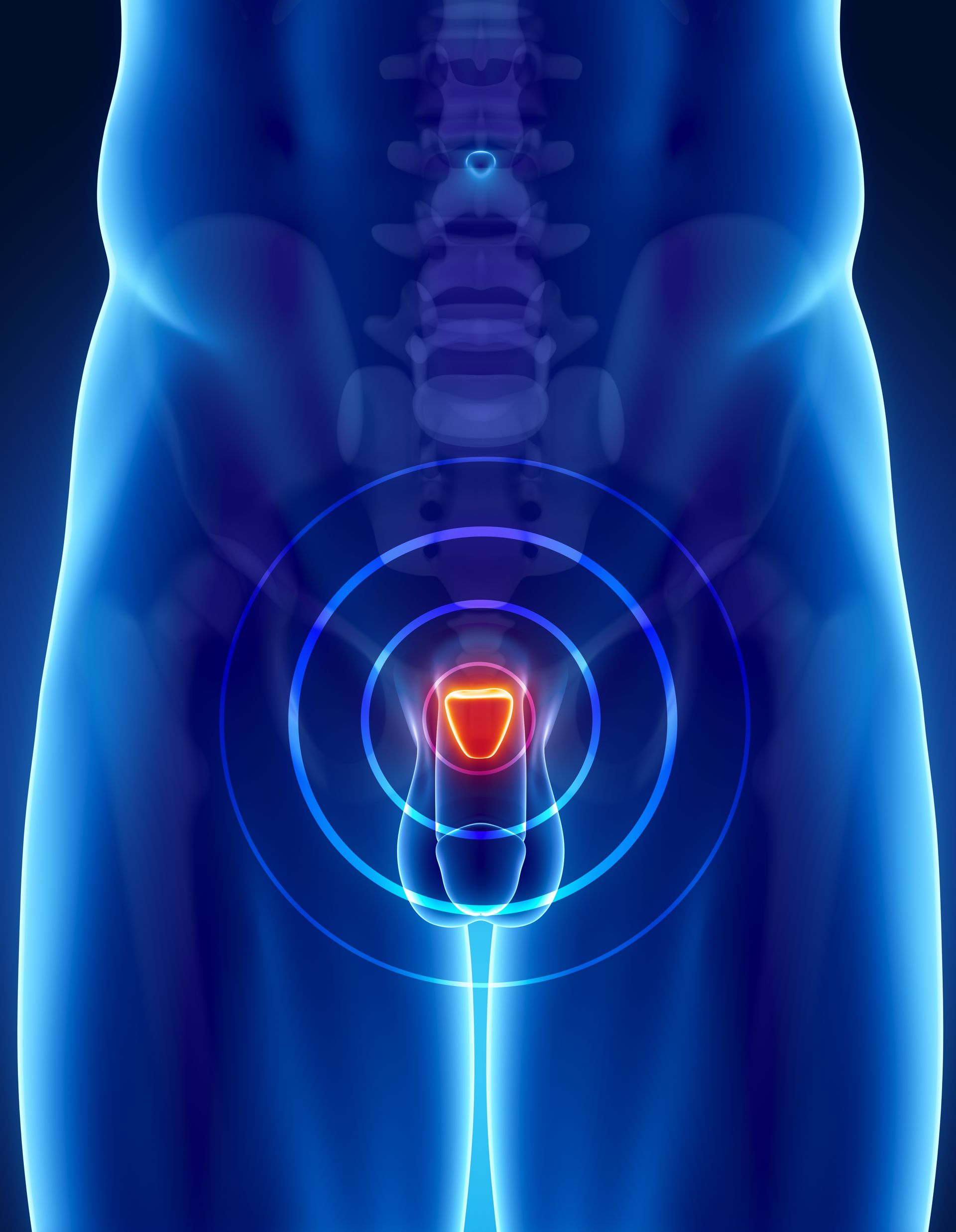 Ilustração médica azul de uma pélvis com próstata destacada e anéis-alvo concêntricos.