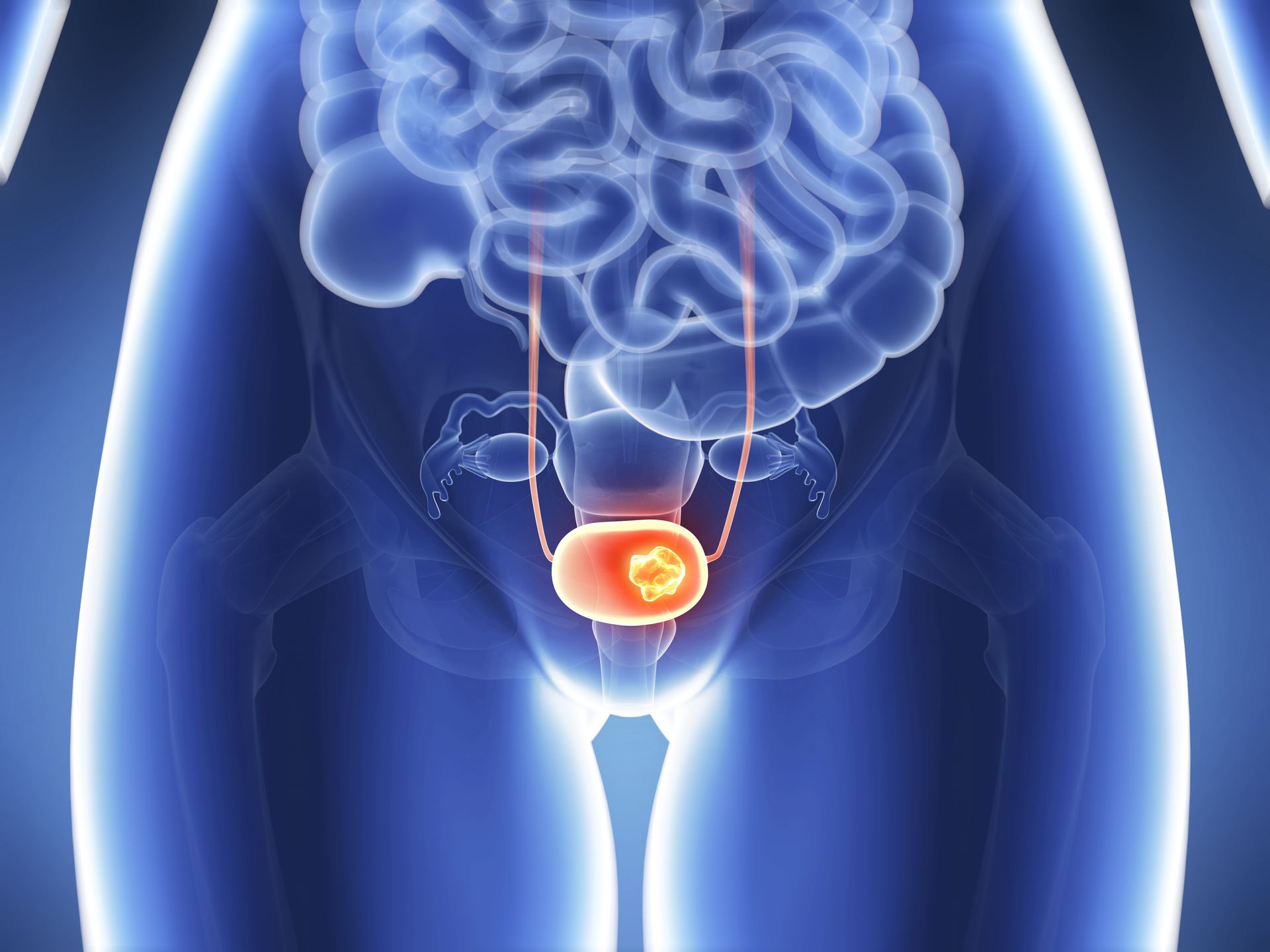 Ilustração médica azul de uma bexiga com um tumor cancerígeno brilhante no centro, conectado aos rins e ao cérebro.