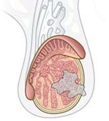 cancer de testiculo