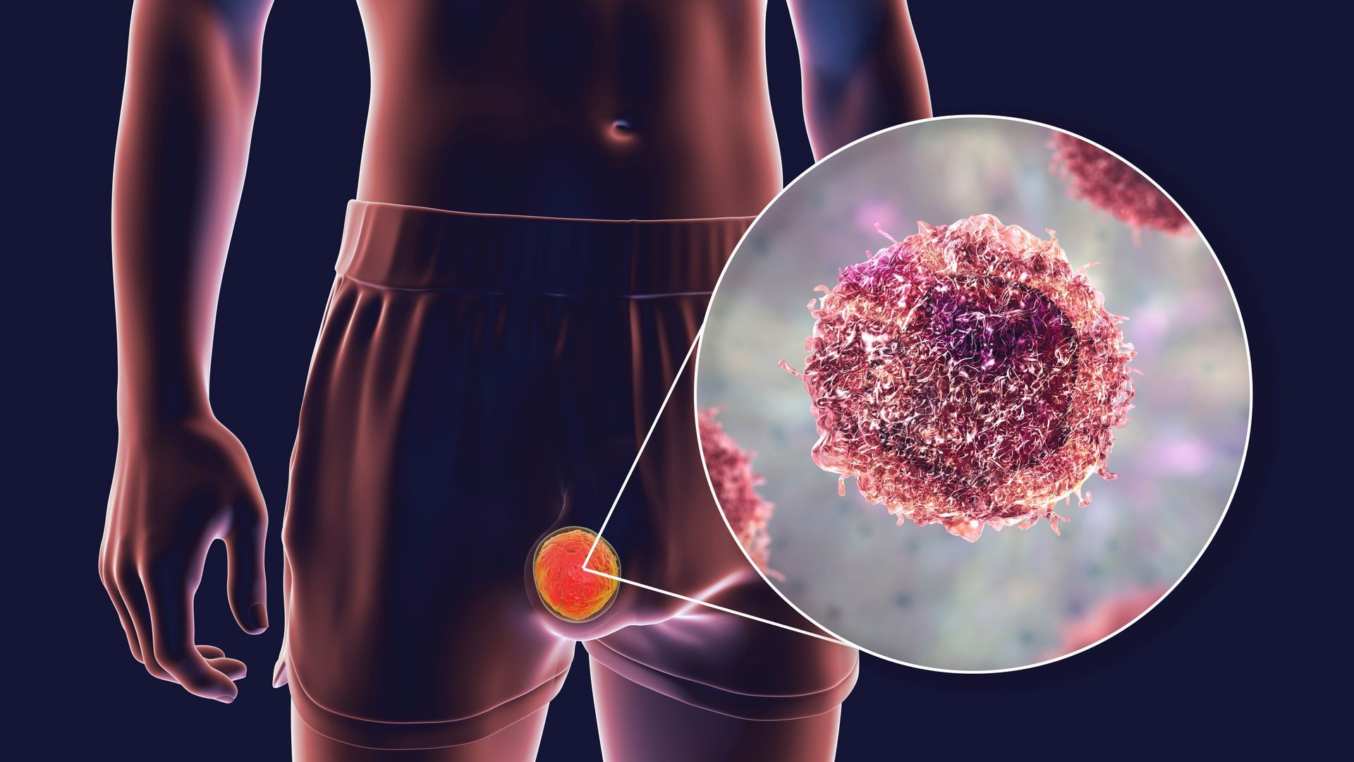 Ilustração da parte inferior do corpo humano com uma ampliação destacando um vírus na região do quad