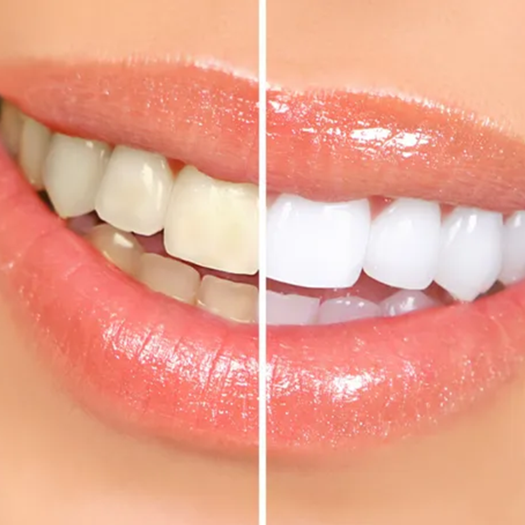 Comparison of teeth: left side is yellowed, right side is bright white, both in a smiling mouth.