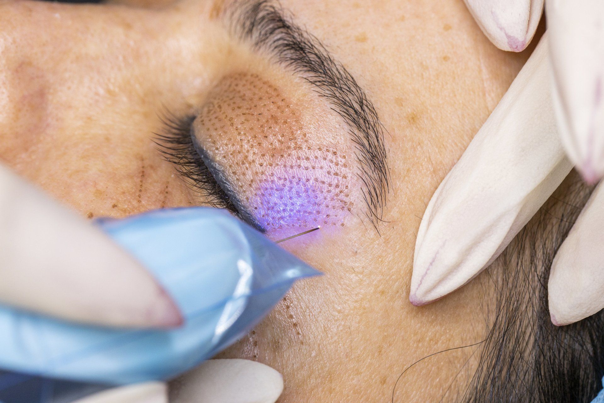 Cosmetician using plasma pen on a woman's eyelid, close-up. Purple light, gloved hands, setting in a salon.