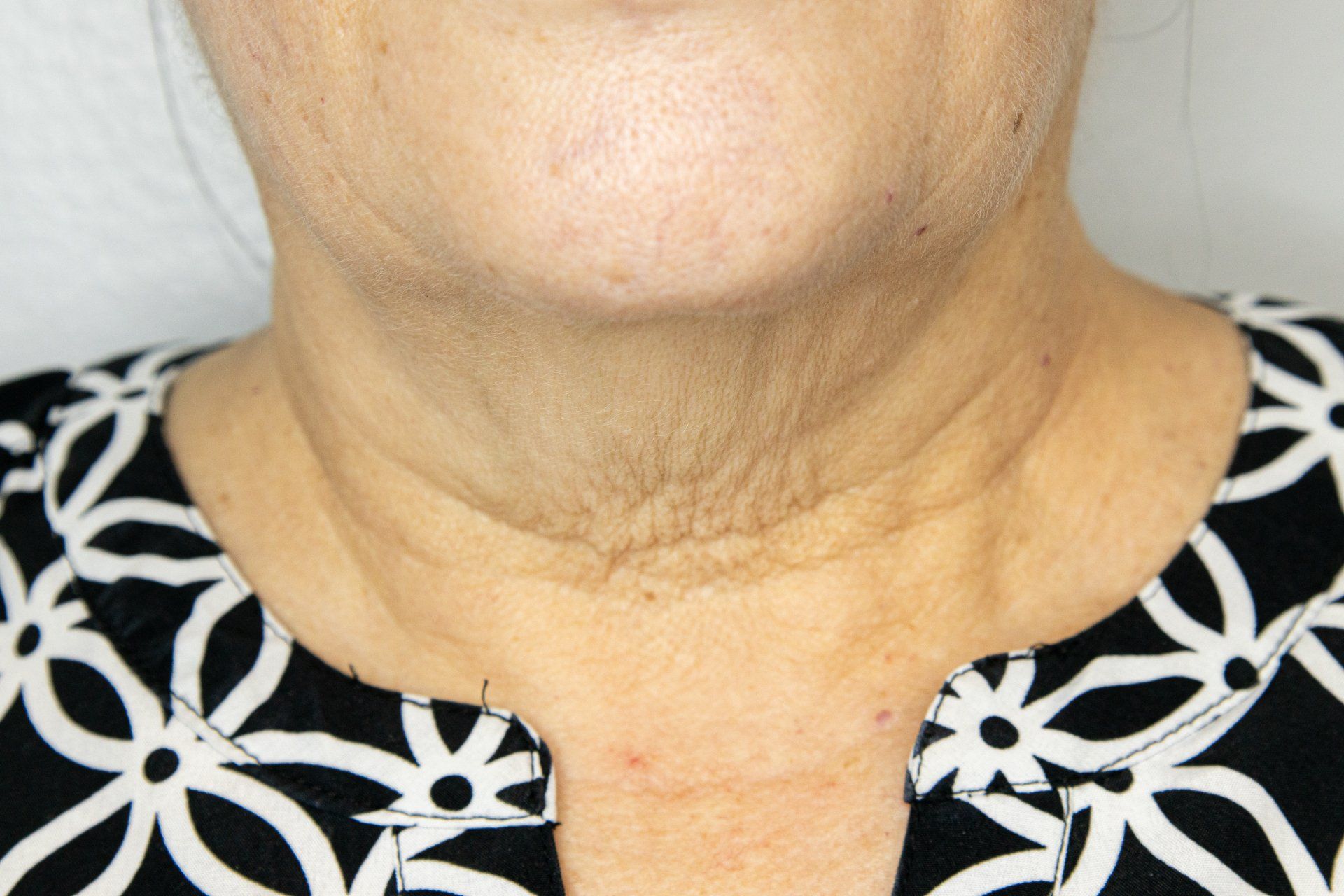 Close-up of a person's neck showing wrinkles, sun damage, and a dark shadow line. They wear a black and white patterned shirt.