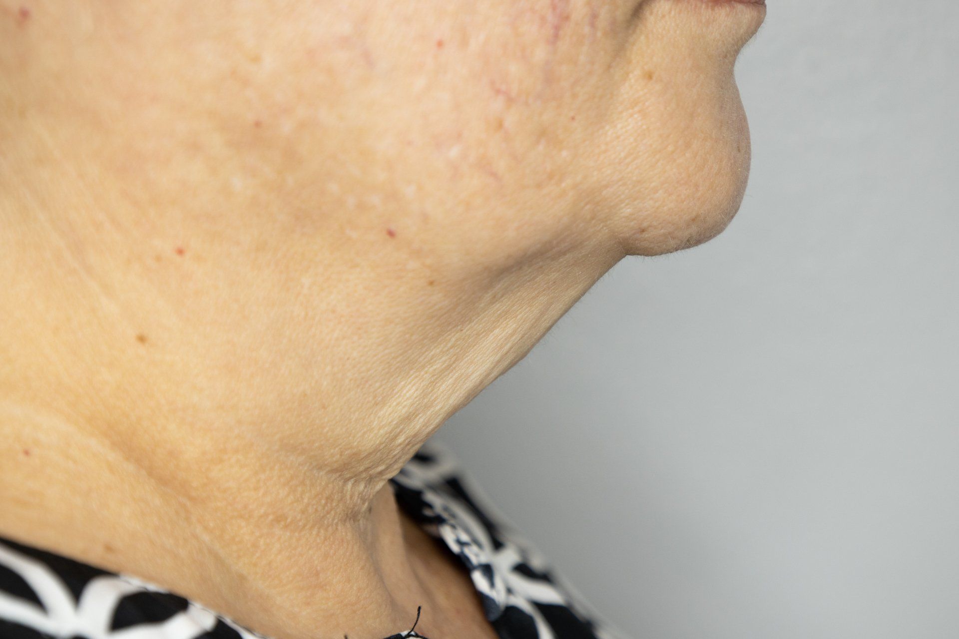 Close-up of a person's neck and chin, showing wrinkles and skin texture.