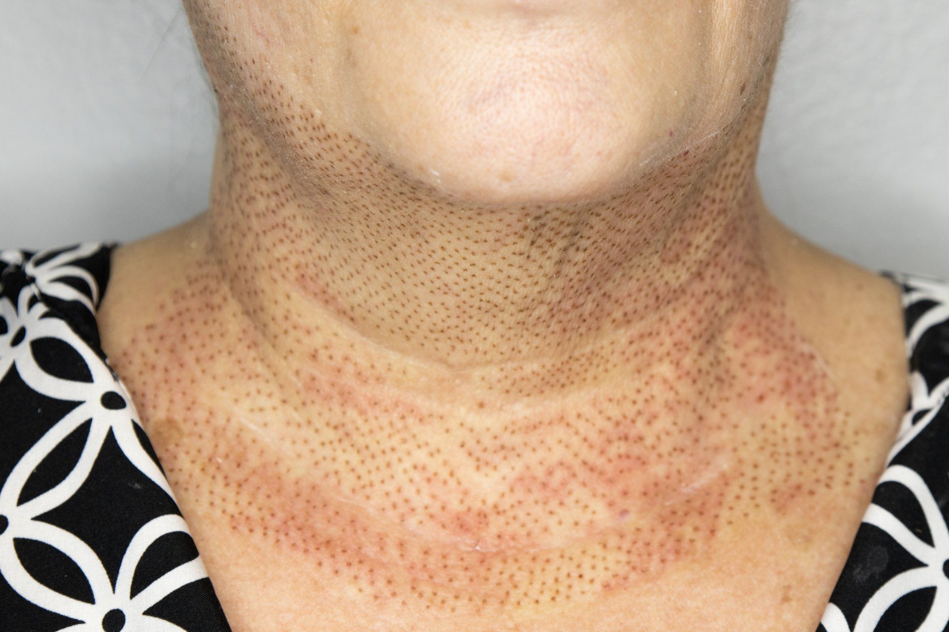 Neck with pinpointed, red dots; possibly post-procedure or skin treatment. Person wearing black and white patterned shirt.