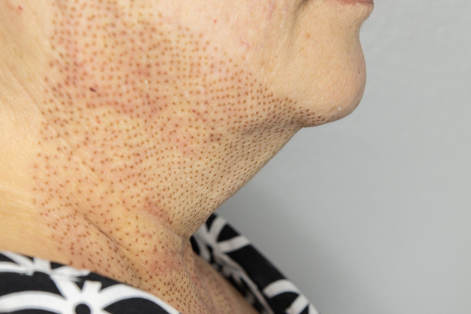 Person's neck and jaw with dotted, reddish marks. Likely skin treatment, close-up shot, against a light wall.