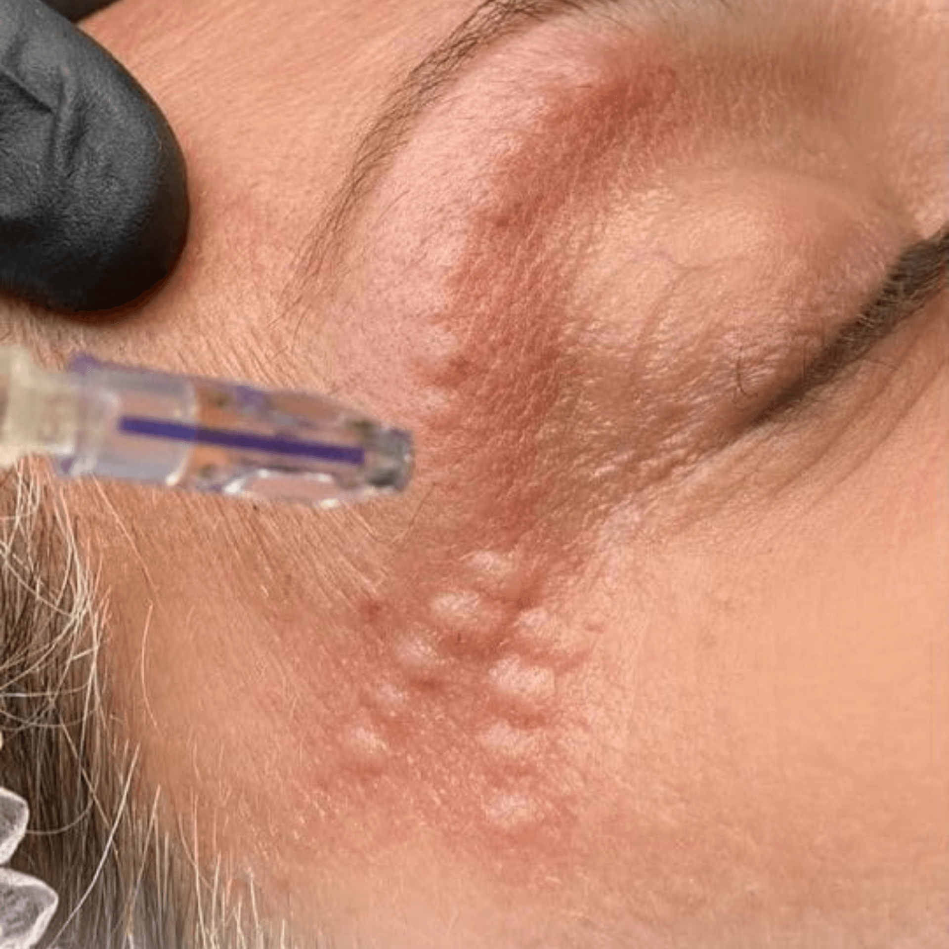 Needle injecting skin near closed eye, causing raised, bumpy areas.
