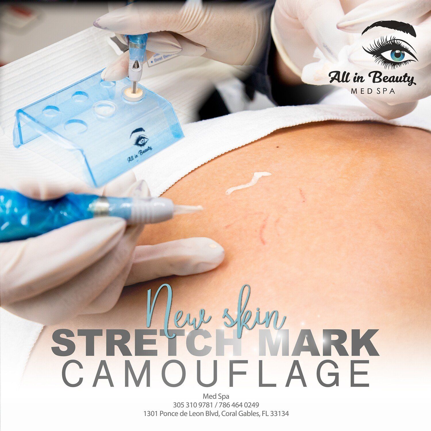 Stretch mark camouflage procedure at All In Beauty Med Spa. Hands with blue tattoo tool on skin, light blue holder, text.