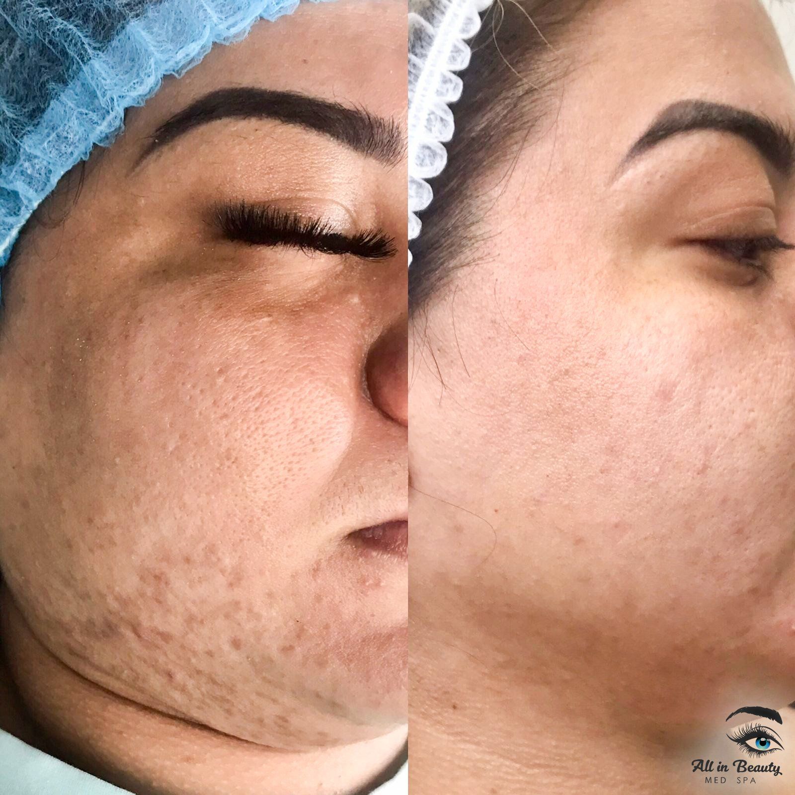 Before-and-after of a person's face. Left side: skin with dark spots. Right side: clearer skin.