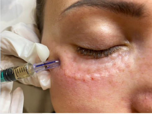 Close-up of a person receiving a facial injection near the eye. A gloved hand holds a syringe.