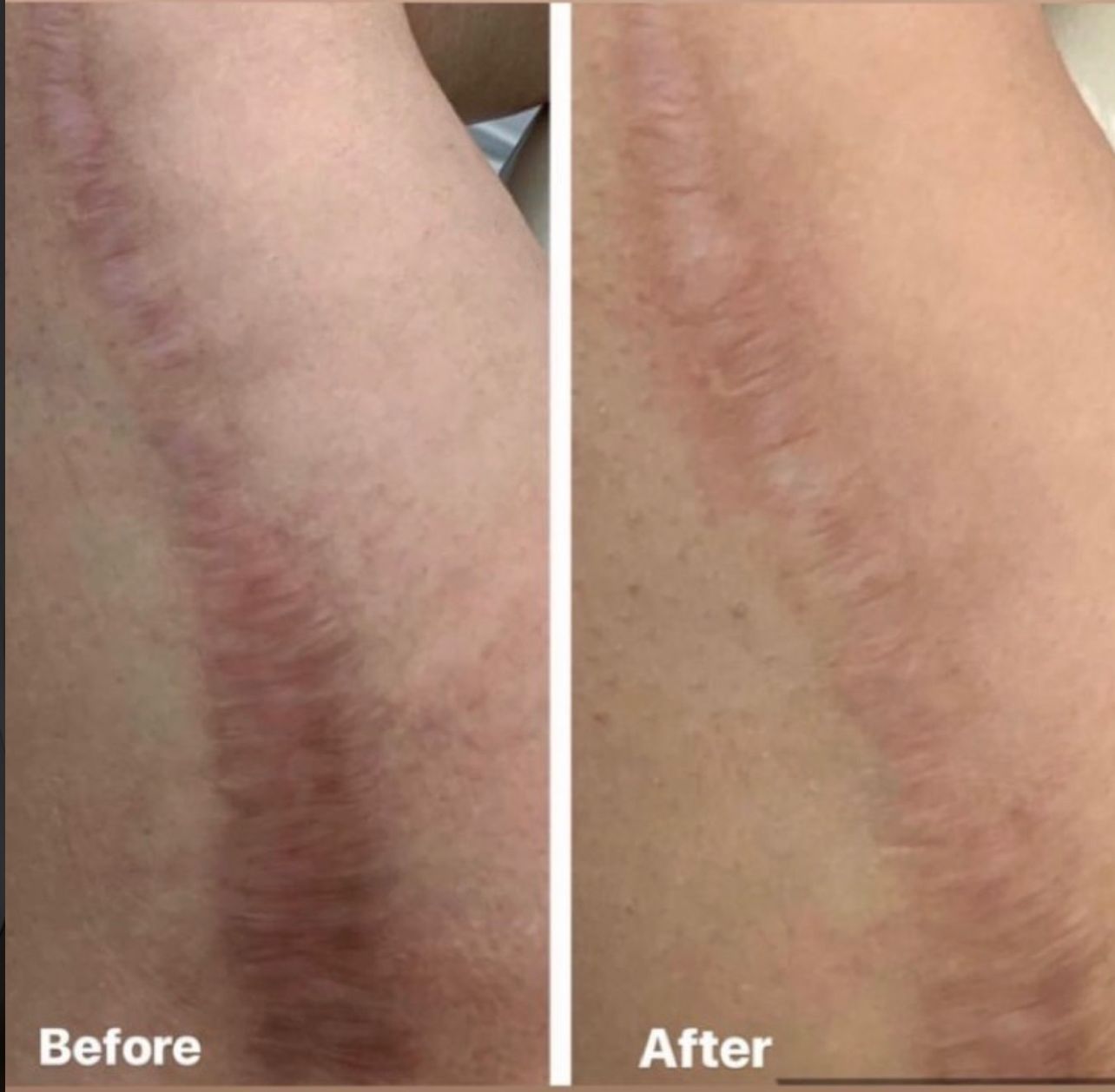 Before and after photos of a scar. The 