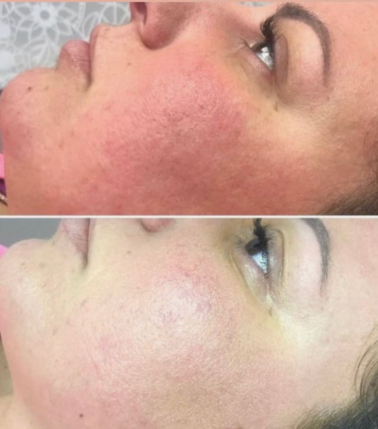 Before and after photos of a woman's face, showing a reduction in redness and skin texture.
