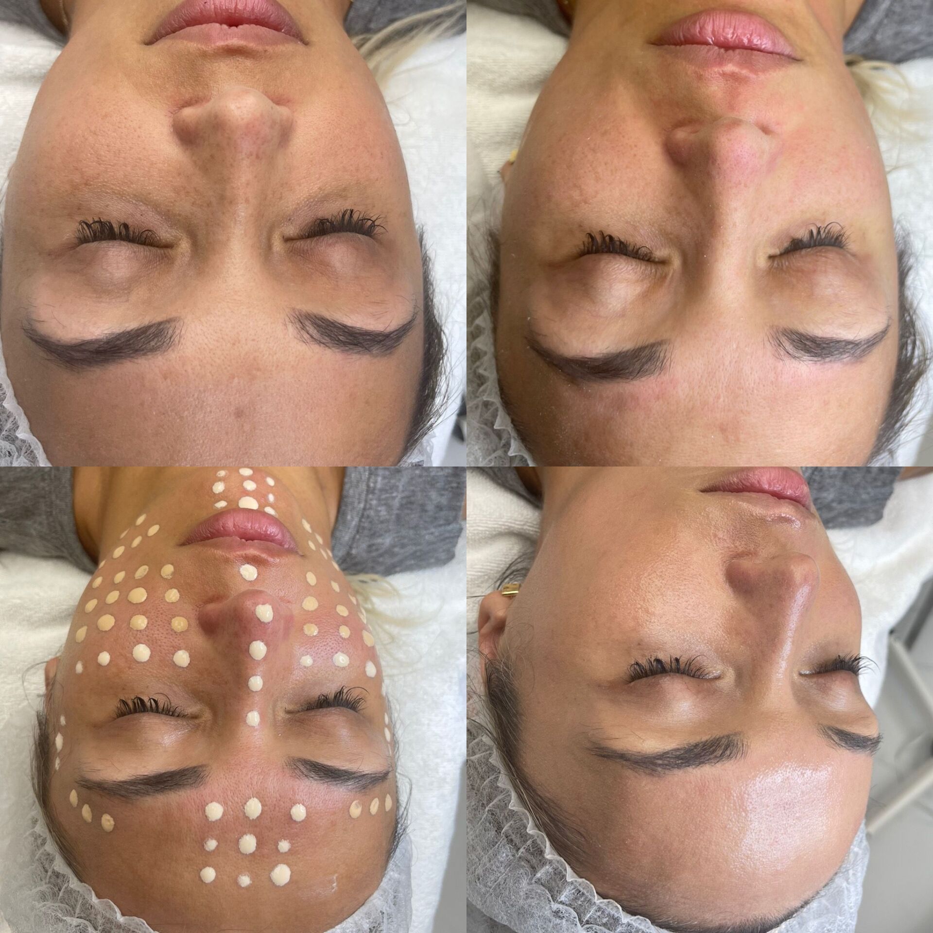 Four photos of a woman's face. Shows pre-treatment, post-treatment, and marked for treatment.