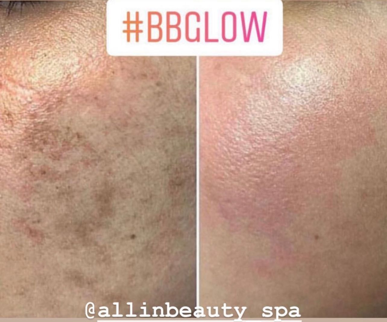 Before-and-after of facial skin, showing improvement after #BBGLOW treatment at a spa. Skin looks smoother and less discolored.