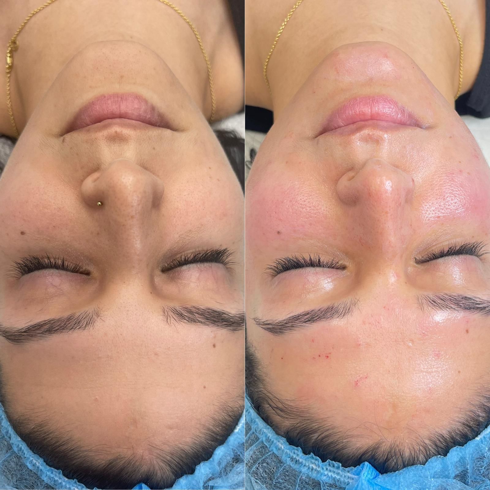 Side-by-side photo of a woman's face before and after a skincare treatment, showing reduced redness.