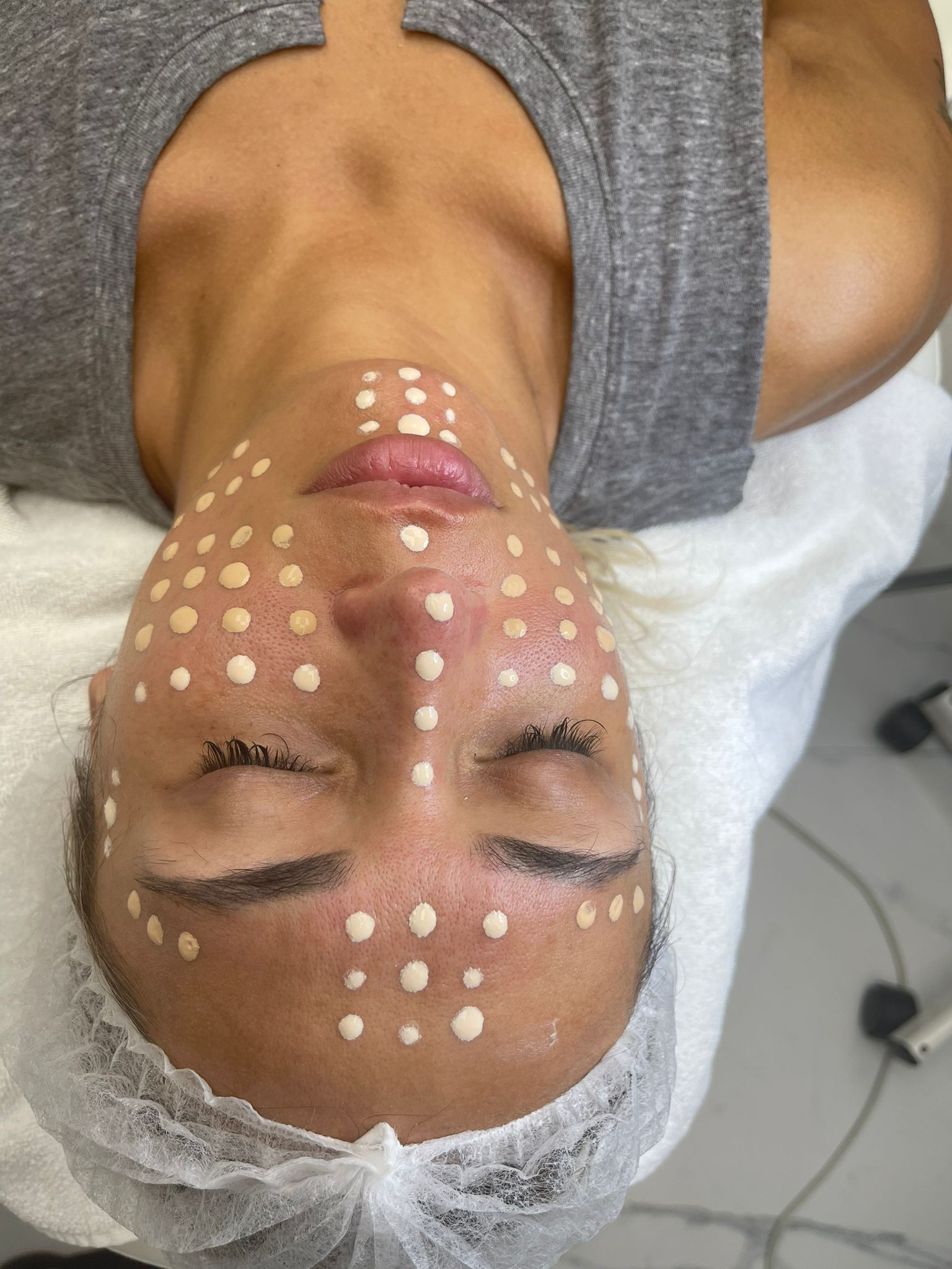 Woman's face with white dots, likely for cosmetic procedure. She's in a medical setting, eyes closed.