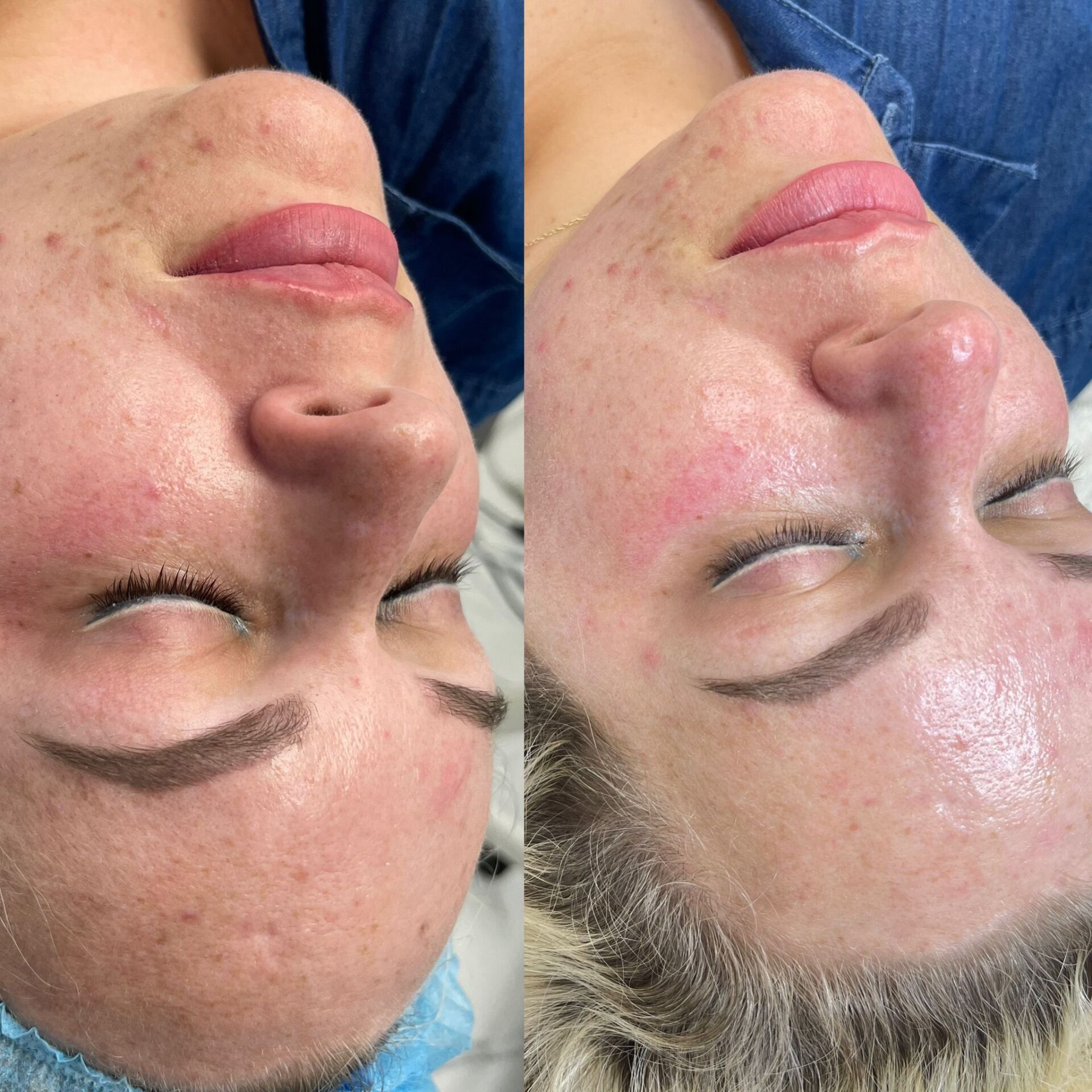 Before and after photos of a person's face; Acne visible on the left side is less visible on the right.
