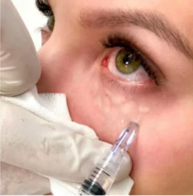 A person receives a filler injection under their eye; a gloved hand holds the syringe.