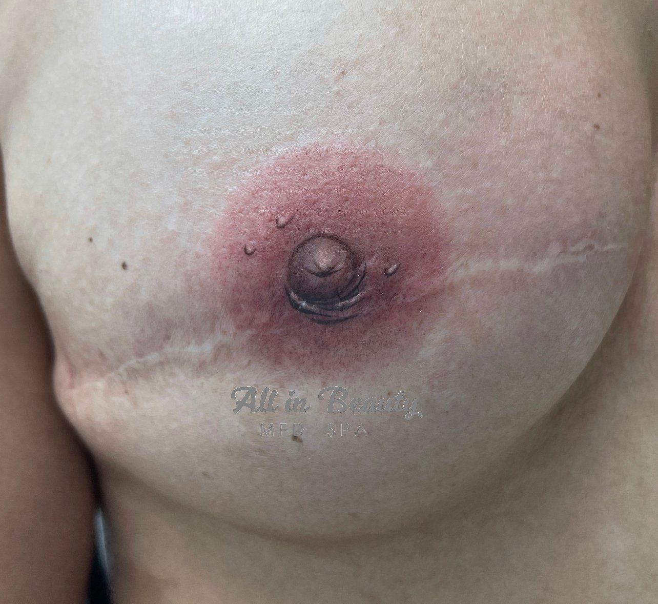 Close-up of a breast with an inflamed, reddish areola. The nipple has small droplets. A scar is visible.
