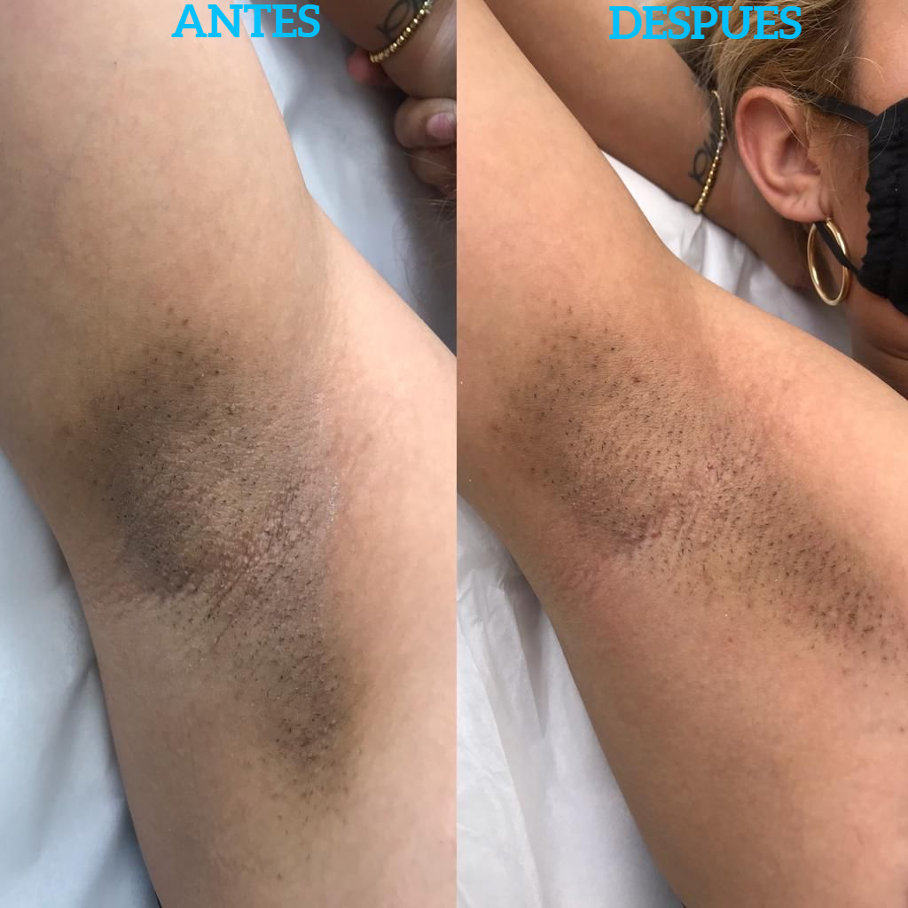 Comparison of armpit before and after hair removal treatment, skin tone varies, showing a reduction in hair.