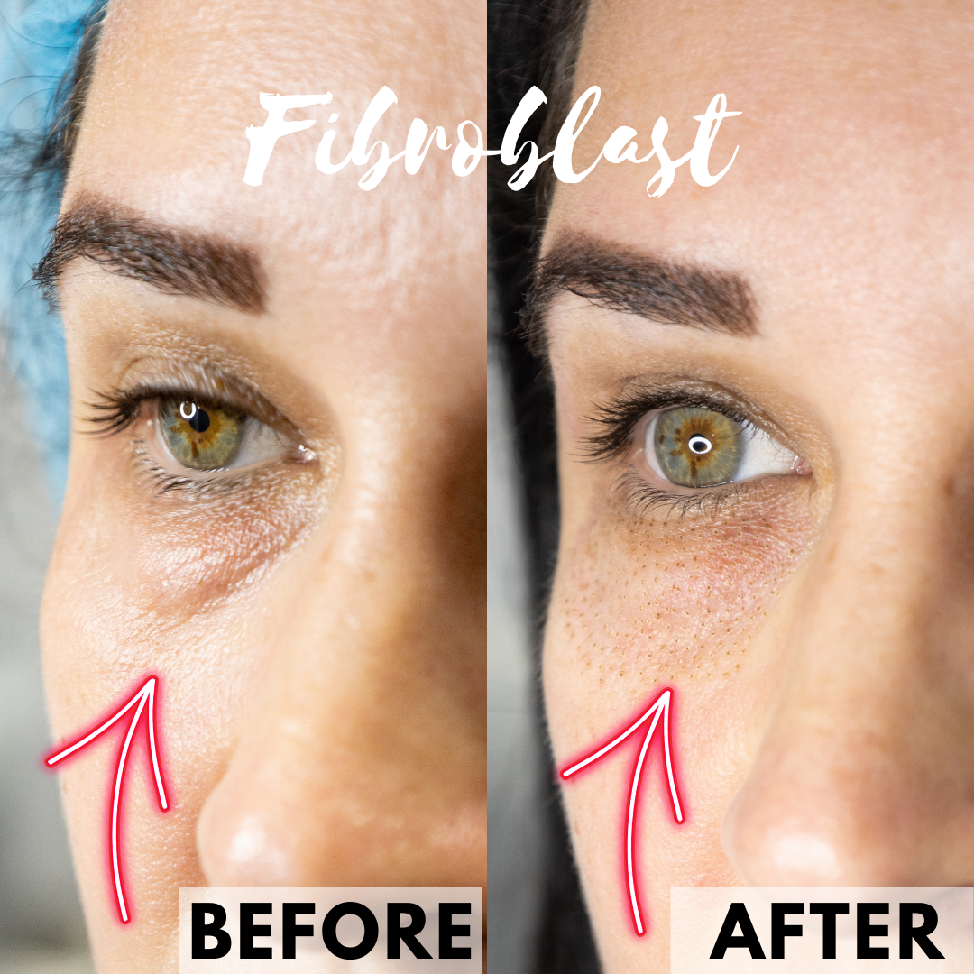 Before and after comparison of fibroblast treatment, showing eye area with reduced wrinkles.