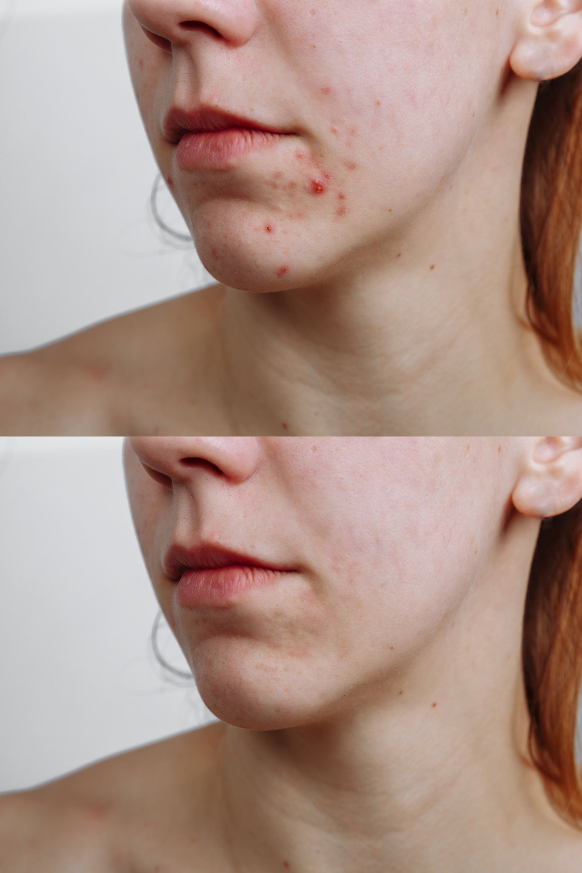 Comparison: Face with acne, then digitally smoothed skin.