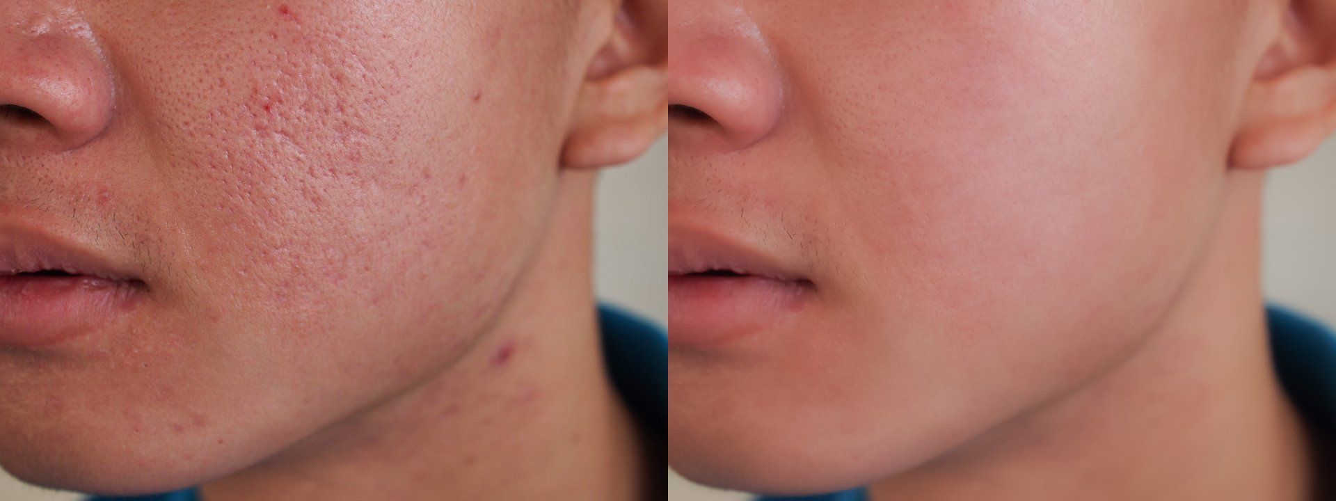 Side-by-side comparison of a person's face. The left side has acne, the right is photoshopped to be smooth.
