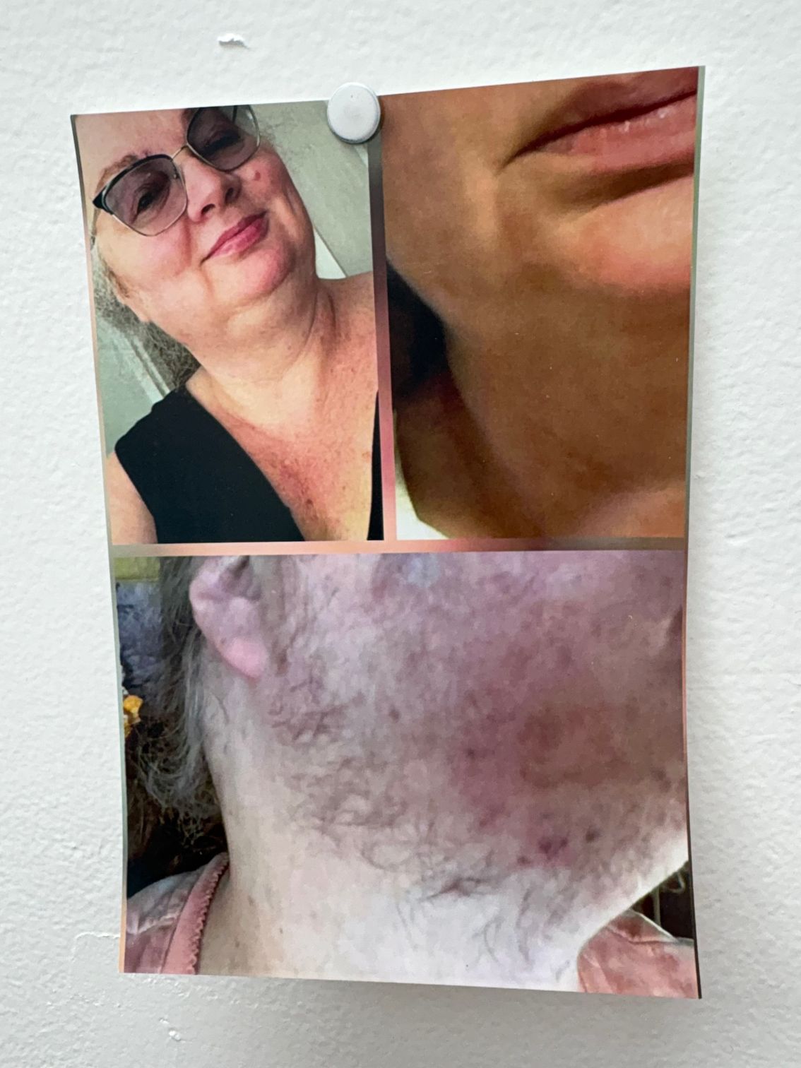 Photo collage: woman in glasses, close-up of face/chin with skin imperfections, and a profile view with facial hair.
